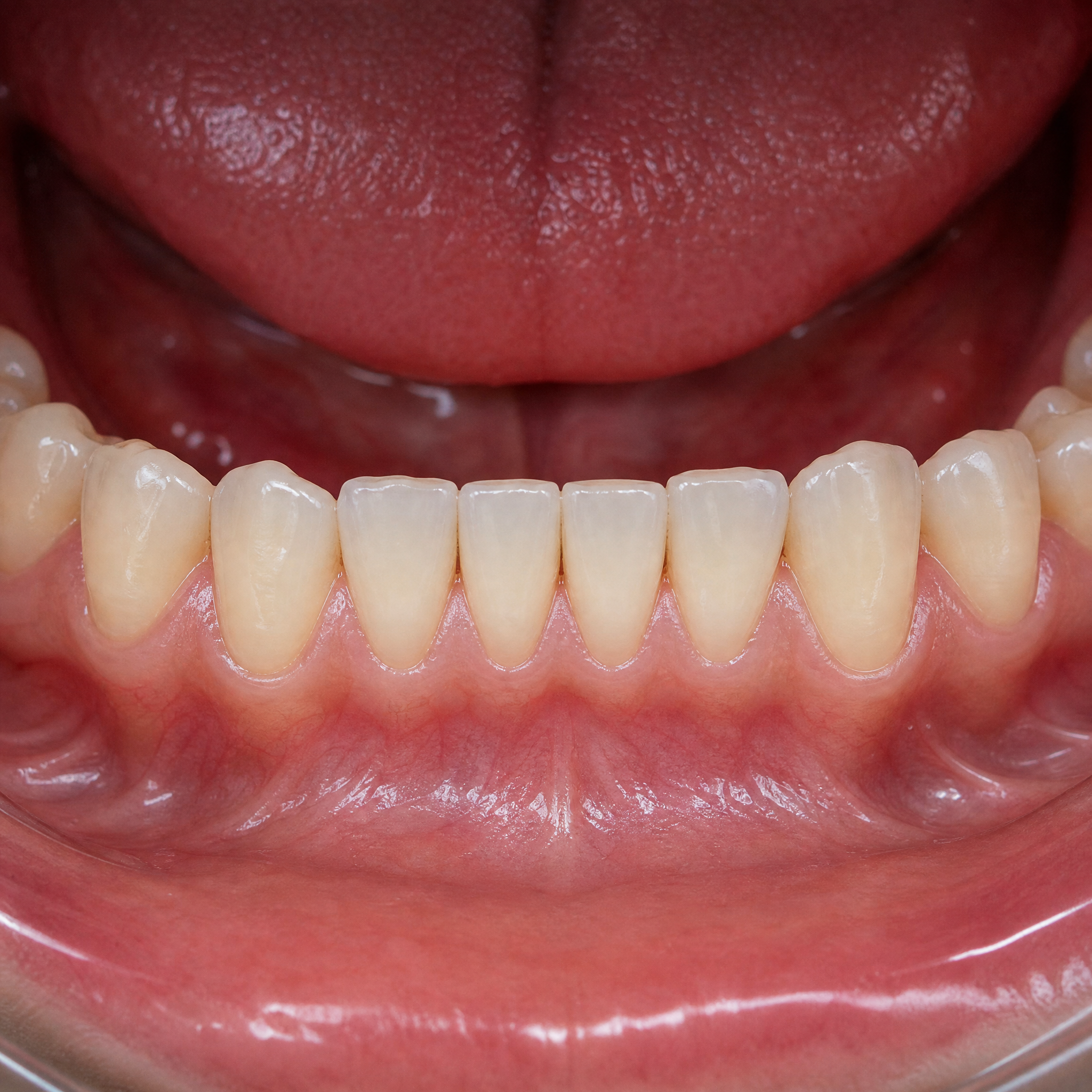After Clear Aligners Treatment
