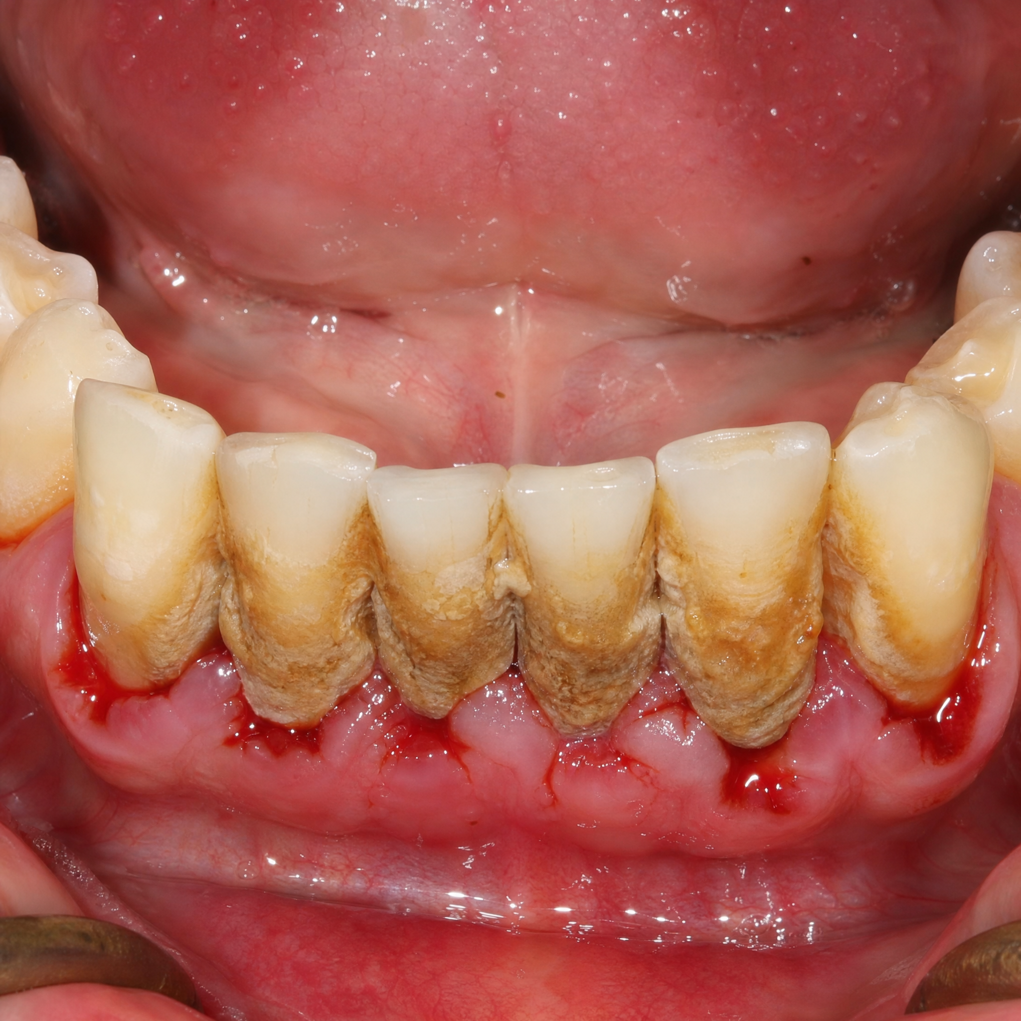 Before Clear Aligners Treatment