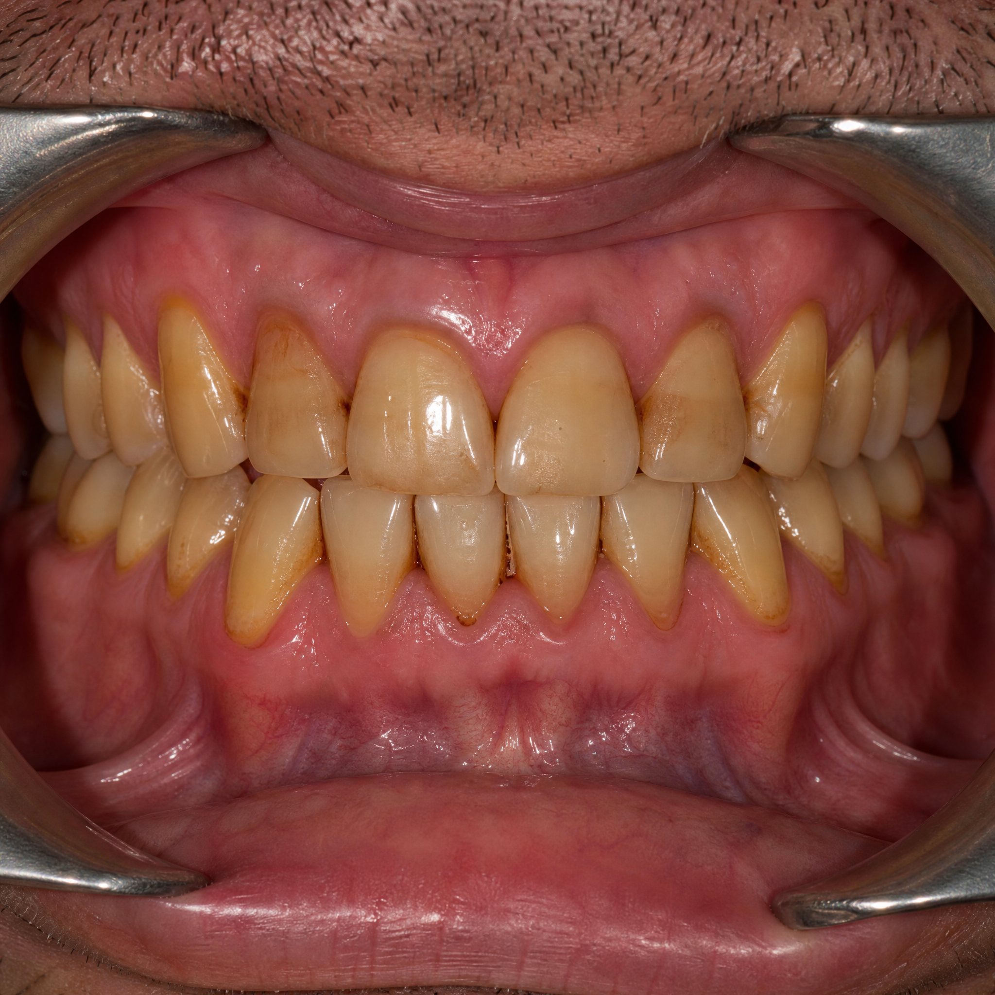 Before Teeth Whitening