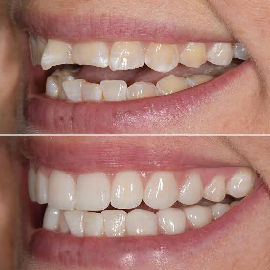 Cosmetic Fillings